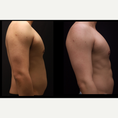 Abdominal Etching before and after photo
