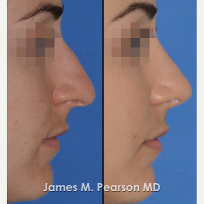 Rhinoplasty before and after photo