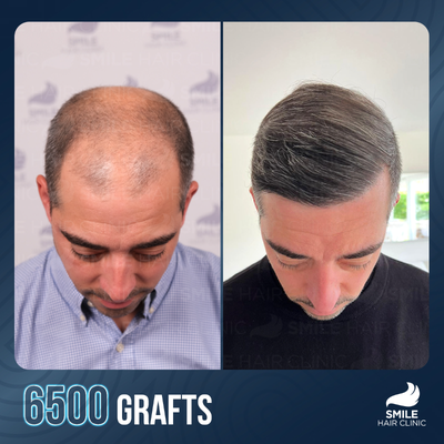 FUE Hair Transplant before and after photo
