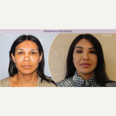 Facial Feminization Surgery before and after photo