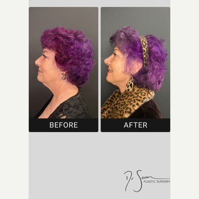 Septoplasty before and after photo