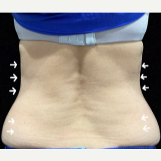 5 Reasons Why Body Sculpting with SculpSure Remains So Popular - Elkins  Park Family Medicine