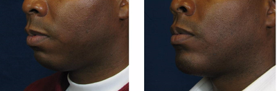 Chin Implant before and after photo