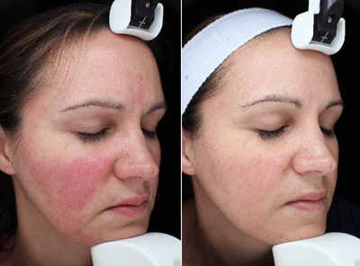 IPL before and after photo