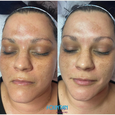 Facial before and after photo