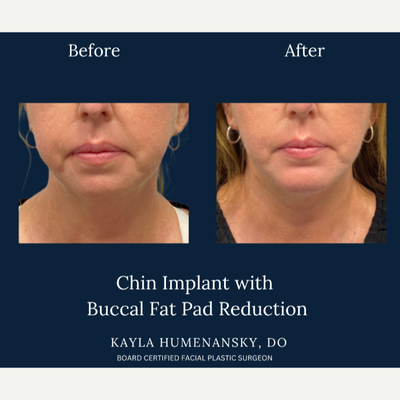 Chin Implant before and after photo