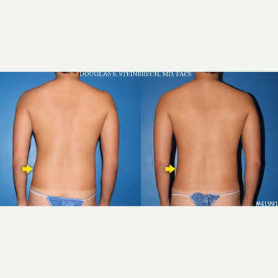 Gynecomastia Surgery before and after photo