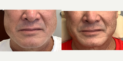 55-64 year old man treated with Botox for Migraines - 58-yr old male  severe TMJ symptoms with 30+ years of headaches clenching and grinding. Wears mouth guard and is on prescription medication for headache pain -  Neurontin, Lyrica and Imitrex.   In Oct. 2020 the patient received Botox (80 units total) in both temporalis muscle and masseter muscles by Dr. Yew. The after photo was taken on Jan/2021  - the patient weight is the same.  Best of all his headaches and clenching were significantly improved and he is off all his prescription meds.   Notice how much slimmer his jawline and profile look now that the masseter hypertrophy is reduced.