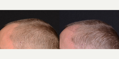 25-34 year old woman treated with Hair Transplant - Patient came in wanting to do something about his receding hairline. Dr. Ho recommended the minimally invasive NeoGraft transplant procedure that has little or no discomfort, a quick recovery time, using the patients own hair follicles from the back of the scalp.