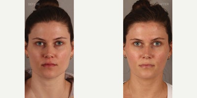 Non-Surgical Jawline Slimming (Botox to Masseters) - 31-year-old female who presented complaining of a square face secondary to masseter (chewing muscle) enlargement. She also complained of pain and tooth damage from grinding and clenching her teeth. She is shown 6 weeks after neurotoxin (Botox) treatment to these muscles, resulting in jawline slimming and a more heart-shaped face. She also has complete relief from her symptoms.