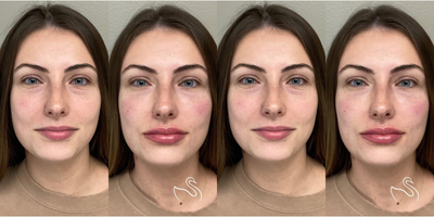 25-34 year old woman treated with Juvederm filler - Cheek and lip filler results at The Skin Center, Columbus!