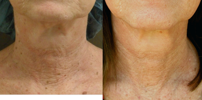 Pixel CO2 - 57 year-old female patient treated with Pixel CO2 for wrinkles and photodamaged skin on neck.