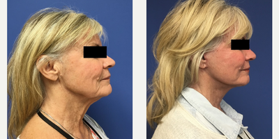 65-74 year old woman treated with Facelift - 72 year old female who wanted a more youthful appearance so she looks as good as she feels. She had a Monarch Mini Facelift with neck liposuction and a platysmaplasty.