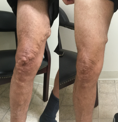 55-64 year old man treated with VenaSeal - Patient treated once with VenaSeal on the right leg. Pictures taken 8 weeks post-procedure.