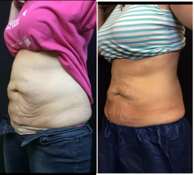 45-54 year old woman treated with Intracel - Followup photos after a series of 4 treatments