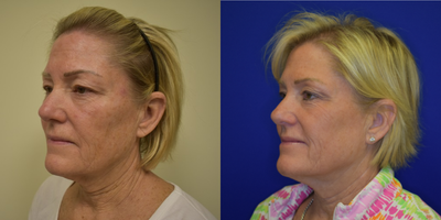 55-64 year old woman treated with CO2 Laser - Client received CO2RE Fractional Resurfacing treatment once. Wanted to improve sun damaged skin, fine lines, and wrinkles.