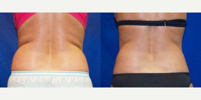 45-54 year old woman treated with Smart Lipo - Patient came in complaining of excess fat to abdomen and love handles. Patient lives a very active lifestyle, trains regularly, etc. After consulting with Dr. Ho, patient elected to have the Smart Lipo procedure to contour her trouble areas.