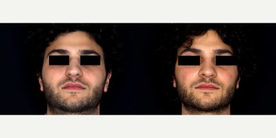 27 year old man treated with Rhinoplasty - 27 year old man treated with Rhinoplasty. Photos depict before and 6 weeks after surgery
