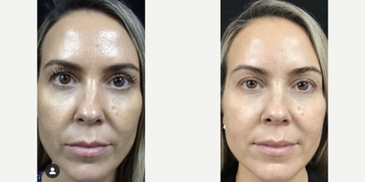 35-44 year old woman treated with Aquagold - Revivify is a quick and pain-free procedure that delicately delivers treatments for improving skin quality and skin health. Immediate results, pain-free, no bleeding, no bruising, and no downtime. Definition of Revivify is to restore to life; to give new life; to revive; to reanimate. Some of the synonyms found in the Thesaurus are words such as: brighten; reactivate; invigorate; recondition; rejuvenate; restore; repair; revitalize; etc.I have coined the name Revivify for this treatment because this is exactly what this treatment does for your skin. It gives an immediate glow to the treated area that only improves over the next few days. We use a very ingenious sterile, disposable device called Aquagold which consists of a small flask and a cap. The flask or bottle is used to mix a cocktail of substances that the doctor prepares for each individual patient according to his/her skin condition. This will include some substances common for all patients such as pure Hyaluronic acid for maximum hydration, 30-50 units of bo-tox (Xeomin), antioxidants, growth factor extracts, a proprietary preparation to stimulate the formation of collagen and elastin, etc. Other substances might be added for specific patients with acne-prone skin/scarring, discoloration, rosacea, etc.The cap has 24 gold-plated, surgical grade, grooved, very short needles that, when softly pressed against the patient, will penetrate into the skin (without going through) and a pumping mechanism is activated forcing the cocktail preparation directly into the thickness of the skin, therefore producing an immediate effect.The procedure is pain-free, bloodless, and takes about 45 minutes to perform for an area such as the face and neck. It can be performed in any area of the body including delicate areas such as the eyelids, lips, and ears, without any bruising or downtime. The most typical areas treated include Face, Neck, Dcolletage, Hands.