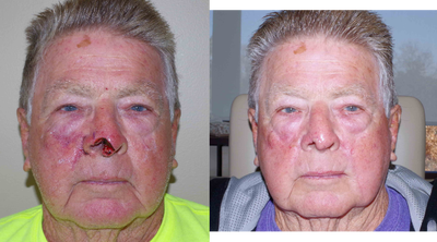 75 and up year old man treated with Facial Reconstructive Surgery with Skin Graft - 81 year old male patient received a MOHs Repair with Skin Graft; photos depict the patient's results 1 month post-op.
