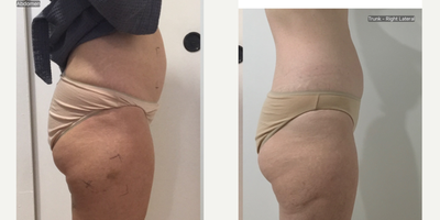 55-64 year old woman treated with truSculpt 3D, Skin Tightening, Carboxytherapy, Skin Rejuvenation - Female wanting to slim lower belly and saddlebag Trusculpt 3D and Carboxy therapy were used. Single session of trusculpt and 1 weekly sessions of Carboxytherapy post trusculpt to speed results.