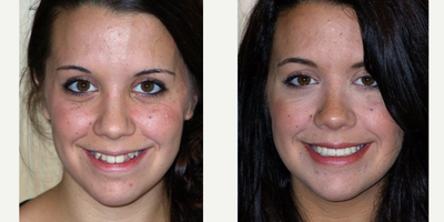 18-24 year old woman treated with Six Month Smiles - Patient wanted her smile straightened in a quicker amount of time.