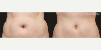 Woman treated with CoolSculpting - Woman treated with CoolSculpting