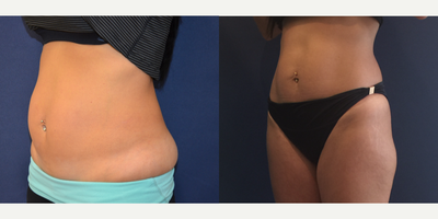 35-44 year old woman treated with CoolSculpting - Before and after CoolSculpting of the upper and lower abdomen (1 treatment, 2 cycles/areas)