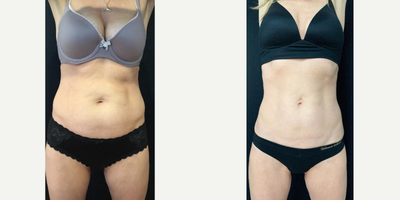 35-44 year old woman treated with CoolTone - This 54 year old patient was treated with 6 CoolTone treatments to achieve this toned appearance of the abdomen. CoolTone is an FDA cleared non surgical treatment to tone and strengthen your core, glutes, and thighs.