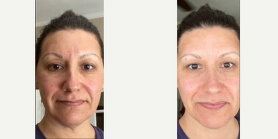Woman treated with Aquagold - Woman treated with Aquagold