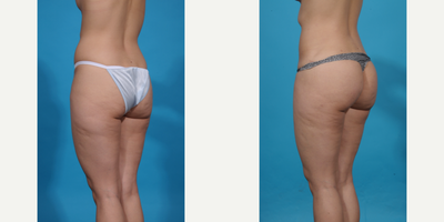 25-34 year old woman treated with Brazilian Butt Lift, Brazilian Butt Lift Revision, Butt Augmentation, Butt Lift, Liposculpture - Skinny BBL. This patient wanted better shape and curves without too much volume. A skinny BBL prioritizes shape over size and is perfect for athletic women who just need a better shape, more curves, and projection but don't want too much volume in their butt. We call this a skinny BBL.