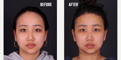 18-24 year old woman treated with Forehead Reduction - surgical forehead reduction