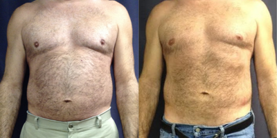 45-54 year old man treated with SculpSure - Before and after a single session of SculpSure- Abdomen