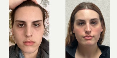 18-24 year old woman treated with Forehead Reduction, Brow Lift, Facial Feminization Surgery, Facial Reconstructive Surgery - This is a young lady who underwent forehead feminization surgery and chin reduction.