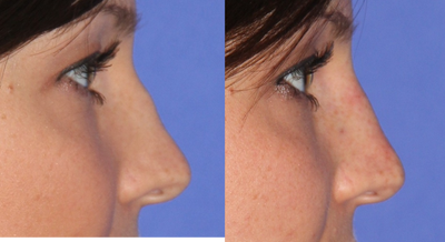 18-24 year old woman treated with Non Surgical Nose Job - Belotero injected to reduce crooked appearance, with subtle change to profile