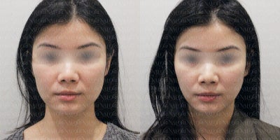 25-34 year old woman treated with Ultherapy, Botox - This patient was treated with Ultherapy to lift and contour the lower face and jawline, along with Masseter Botox to slim the jaw and reduce facial width caused by muscle hypertrophy.Results shown 1 month post-treatment.Notice the more defined V-line, lifted cheeks, and softer jawlineespecially visible around the lower face and under the chin. The combination approach offered both lifting and slimming without downtime.