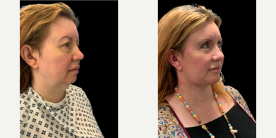 Woman treated with Brow Lift - Woman treated with Endoscopic Brow Lift shown 6 months post op. She also had facelift, neck lift with platysmaplasty, upper blepharoplasty, submental liposuction and chin implant.