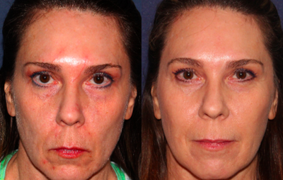 45-54 year old woman treated with ResurFX for scars - Before and after ResurFX laser treatment for scar reduction