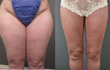 45-54 year old woman treated with Liposuction for Lipedema - Woman suffering from Lipedema pain undergoes liposuction surgery to remove diseased fat from her calves, ankles and thighs.