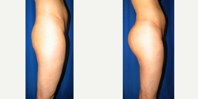 Woman treated with Butt Augmentation - Woman treated with Butt Augmentation using implants