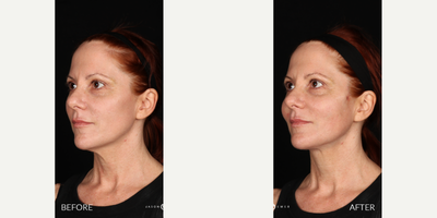 35-44 year old woman treated with Miracu - Our patient came to us after noticing some laxity in her face and wanted to treat her concerns with a noninvasive treatment. She has been worried about the laxity her skin has on her face after she accomplished a dramatic weight loss. She is happy she lost so much weight but it has caused her lower face and neck to drop. She was able to undergo a quick office treatment which left her with results that would last for a whole yearNo treatment is complete without EMER SKIN. Using our products post-treatment will enhance results to the absolute maximum. Click Link in Bio Click Emer Skin