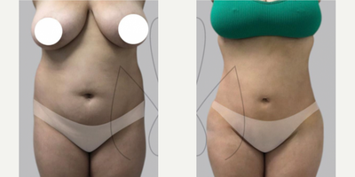 Woman treated with Brazilian Butt Lift - Woman treated with Brazilian Butt Lift