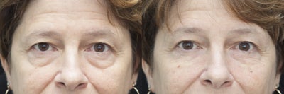 Undereye rejuvenation using Belotero with cannula - 52yo woman with undereye festooning who wanted to avoid blepharoplasty. Belotero was injected using cannula method from one entry point under each eye. A total of 0.3cc per side was injected. The after photo is taken immediately after treatment to show the single entry point.