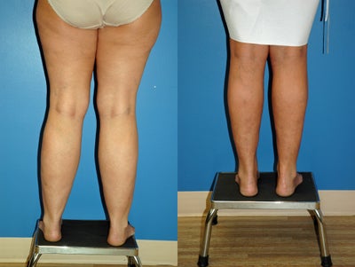 liposuction calves/ankles - liposuction calves/ankles