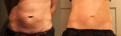 Late 30s Mom Opts for CoolSclupting First  Before Considering Surgery  - Our patient is a mom in her late thirties with a busy, active lifestyle. She has been dissatisfied with the appearance of her lower abdomen since carrying her children. She came to Dr. Capizzi for a consultation on surgical options. Stillwater advised trying the less-invasive CoolSculpting first. The patient has good skin elasticity and  appeared to be a good candidate for CoolSculpting. Dr. Capizzi advised surgical options can always be considered in the future. TREATMENT DETAILS: CoolSculpting coolCore to Bilateral Lower. Abdomen. Photos taken five weeks post procedure.