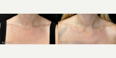 25-34 year old woman treated with Moxi - BBL and Moxi for pigmentation and texture