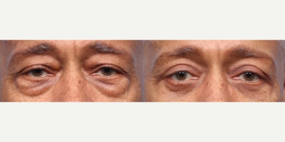 65-74 year old man treated with Eyelid Surgery, Double Eyelid Surgery - At 66, this patient came to Dr. Wise with concerns about droopy eyelids and prominent under-eye bags. After a precise upper and lower blepharoplasty, his eyes look brighter, more refreshed, and years youngerwithout changing his natural expression.