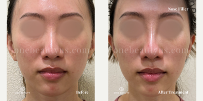 25-34 year old woman treated with Restylaner Lyft - Nose filler - A mid-20s woman received Restylaner Lyft nose filler to elevate her nose bridge, enhancing and balancing her facial structure