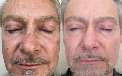 Man treated with BroadBand Light (BBL) - Man treated with BroadBand Light (BBL)