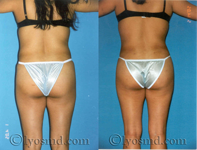 Butock Augmentation - 
	A 28 year-old woman before and after buttock augmentation with 400 cc of her own fat per side combined with tumescent liosuction.
